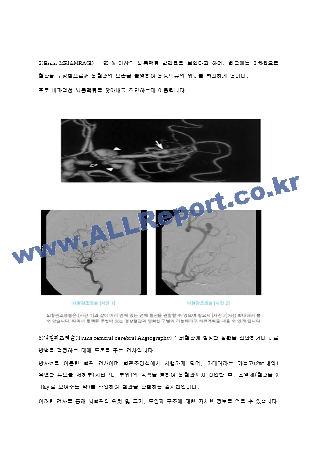 신규 간호사도 이해할 수 있게 만든 뇌동맥류 자료(시술 및 이미지)   (6 페이지)